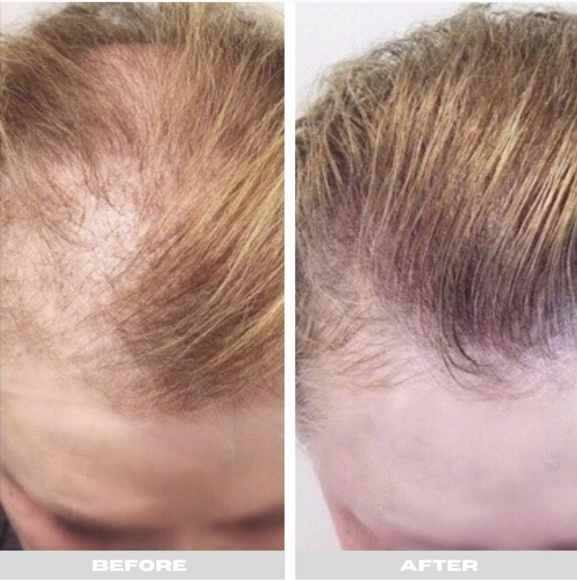 After — PRP hair restoration before and after at Skiin Manchester — fuller coverage on the crown
