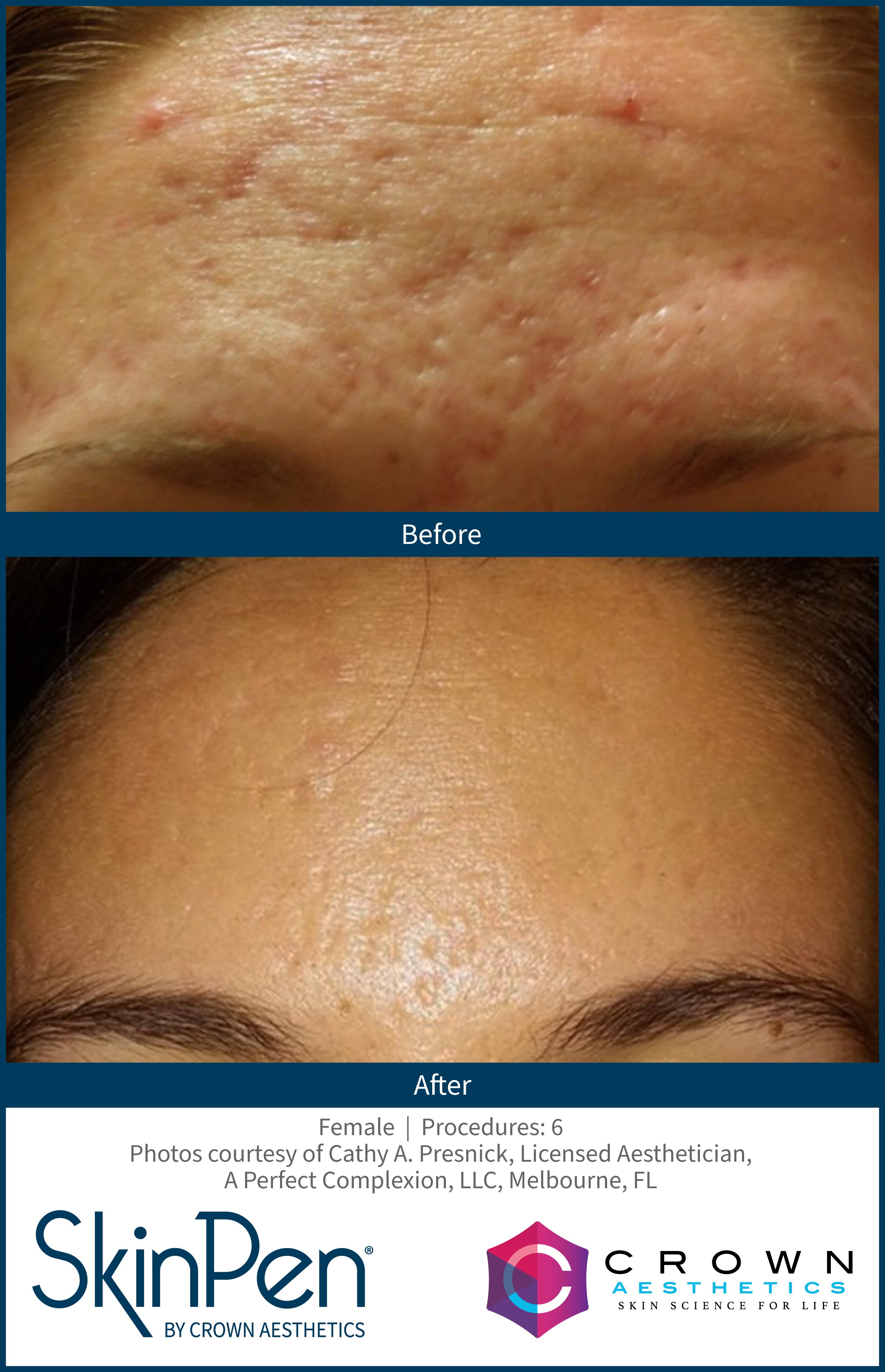 SkinPen microneedling forehead acne scar before and after at Skiin Clinic Manchester