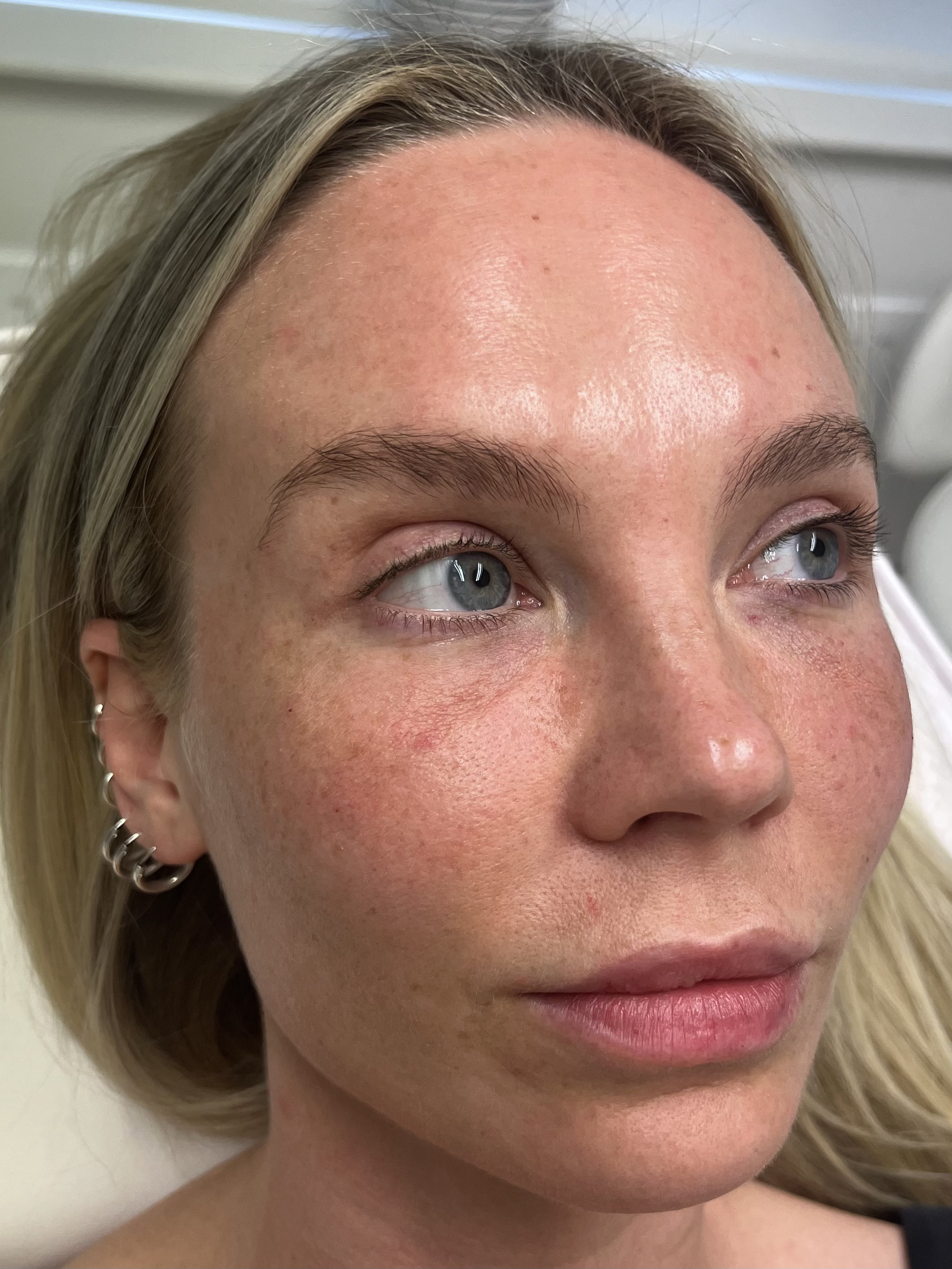 After — Full face rejuvenation before and after — anti-wrinkle treatment and dermal filler at Skiin Clinic Manchester