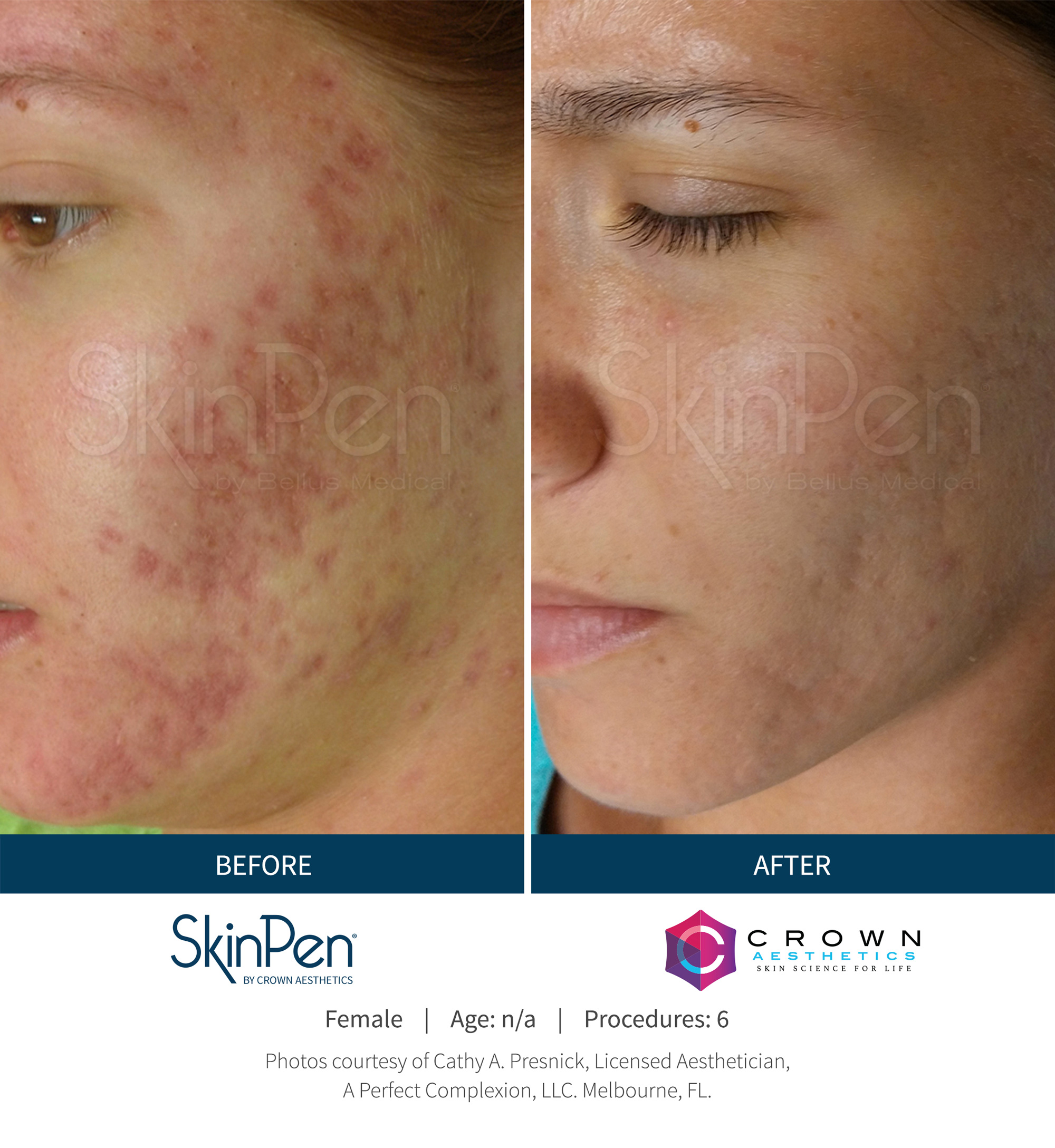 SkinPen microneedling before and after — acne scarring improvement at Skiin Clinic Manchester