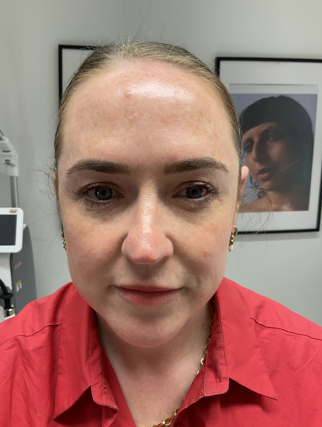 Before — Jawline and chin dermal filler before and after at Skiin Clinic Manchester
