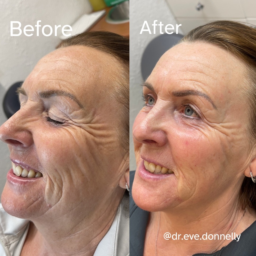After — Sculptra before and after — smoother eye and cheek area at Skiin Clinic Manchester