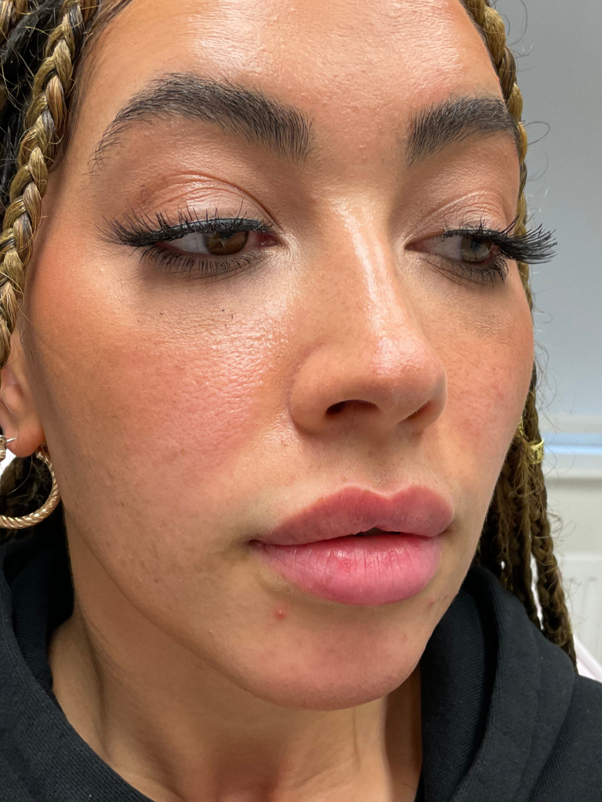 Before — Natural lip filler before and after — border definition at Skiin Clinic Manchester