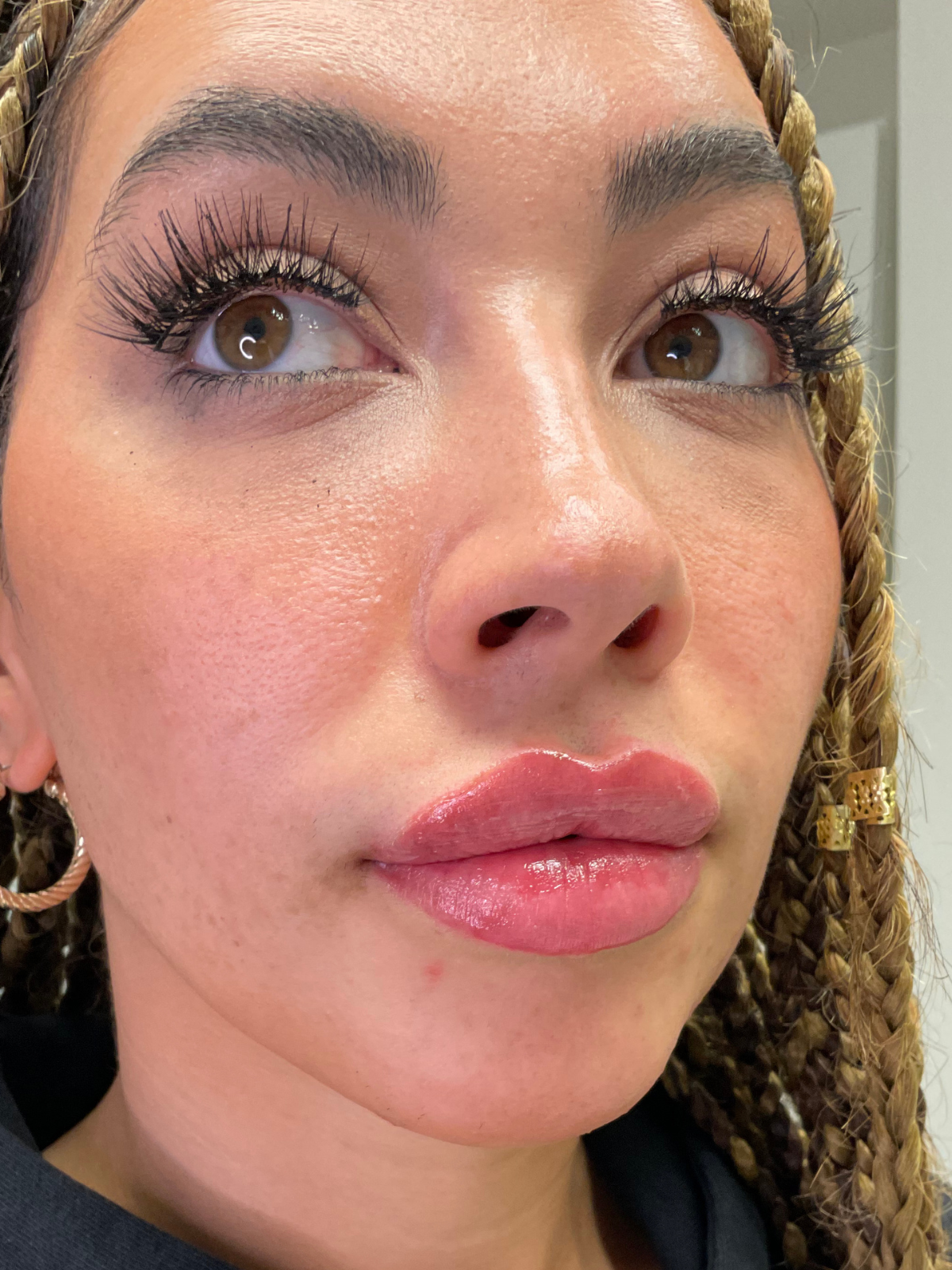 After — Natural lip filler before and after — border definition at Skiin Clinic Manchester