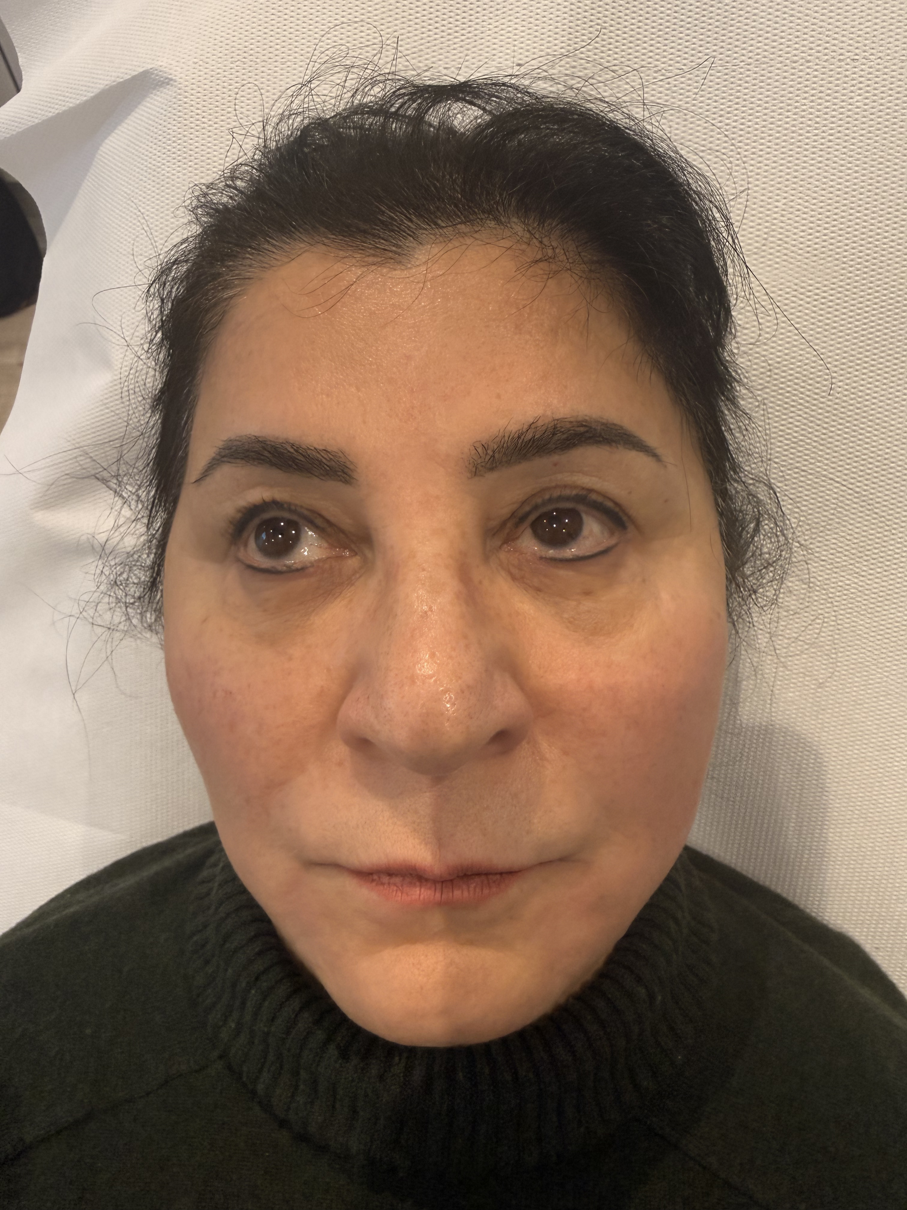 After — Radiesse collagen stimulating filler before and after at Skiin Clinic Manchester