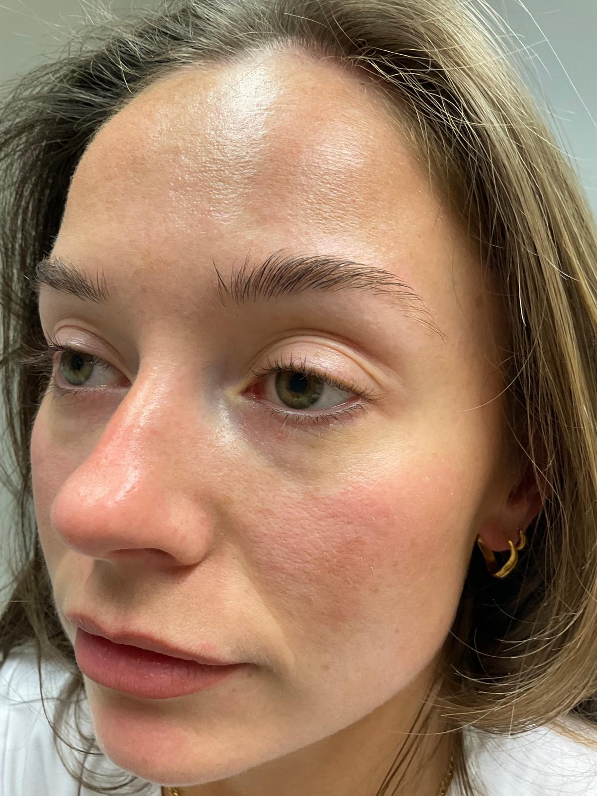 Before — Polynucleotides under-eye treatment before and after at Skiin Clinic Manchester