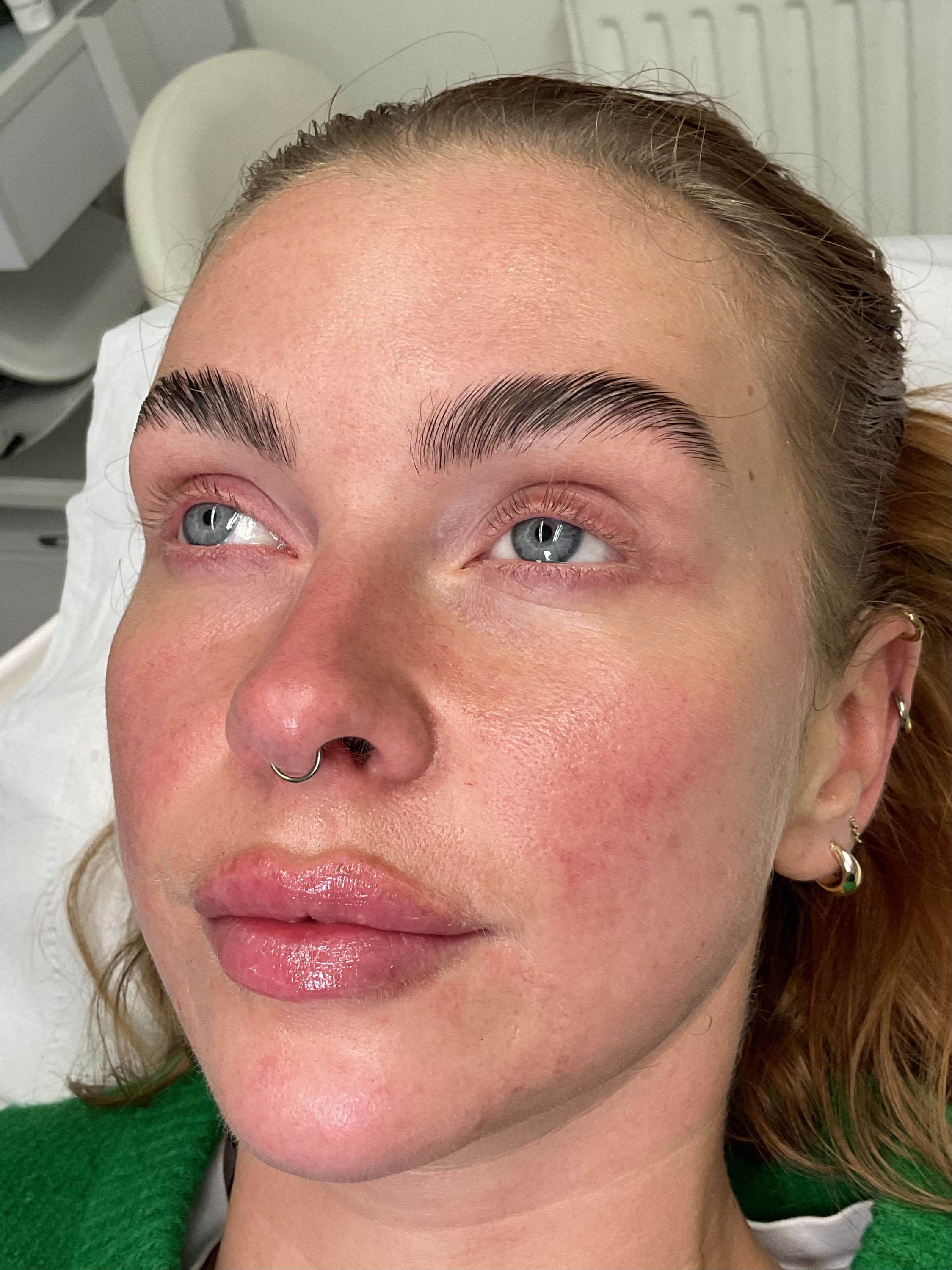 After — Natural lip filler before and after — volume and hydration at Skiin Manchester