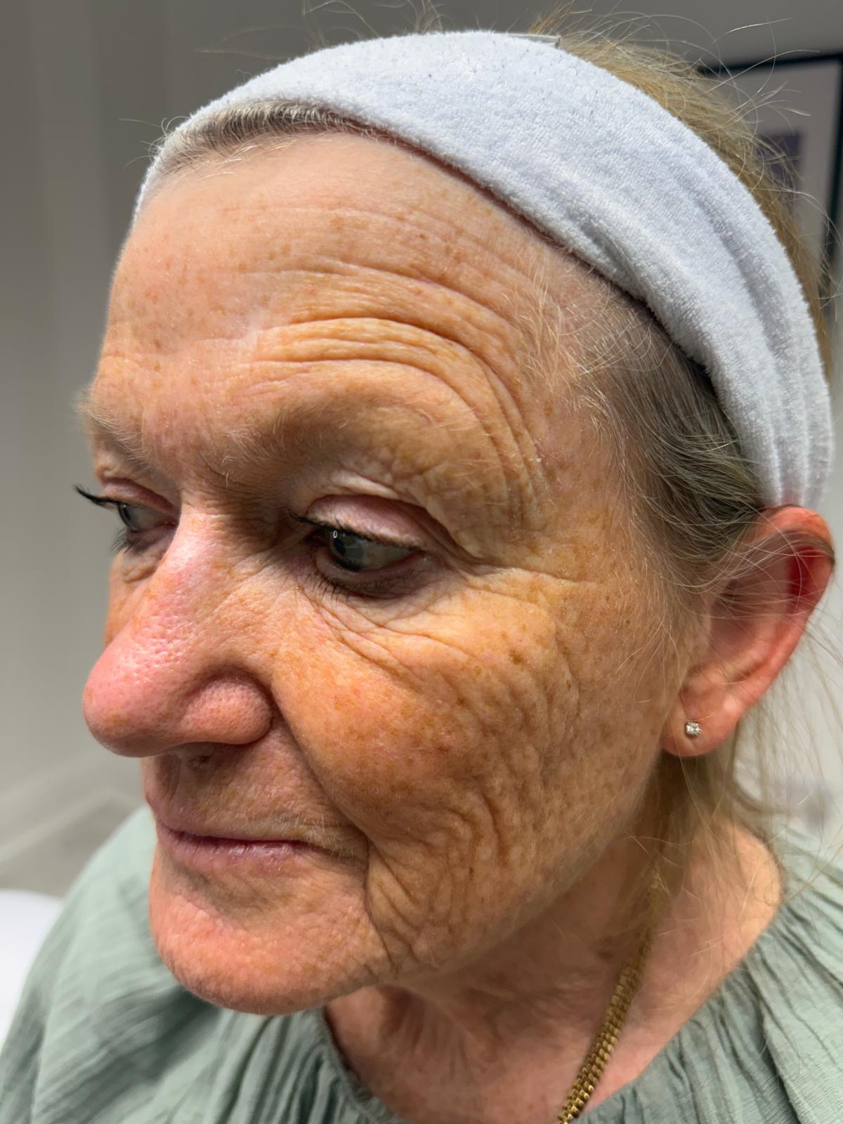 After — LaseMD Ultra with RF microneedling before and after at Skiin Clinic Manchester