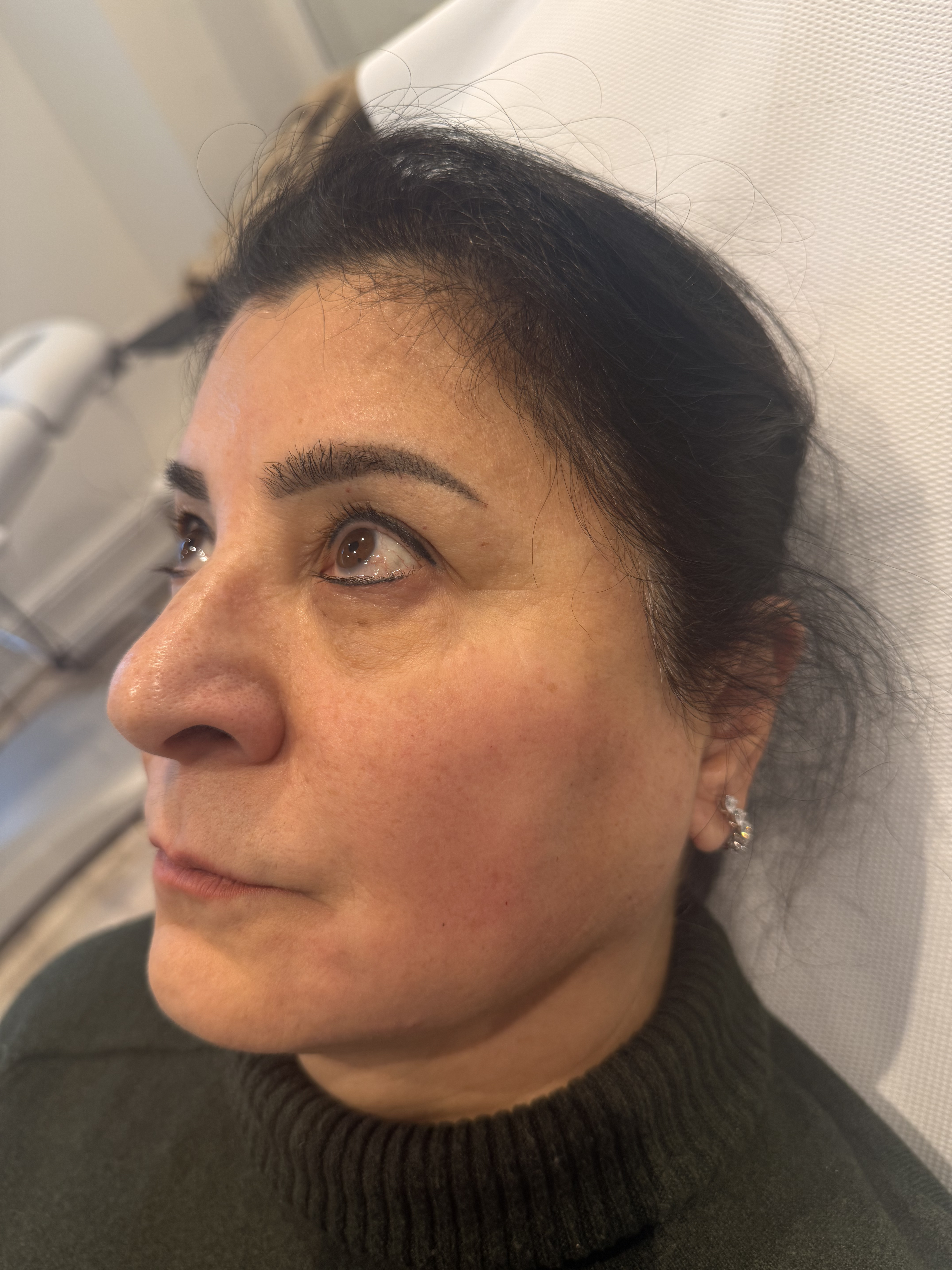 After — Radiesse jawline and profile definition before and after at Skiin Clinic Manchester