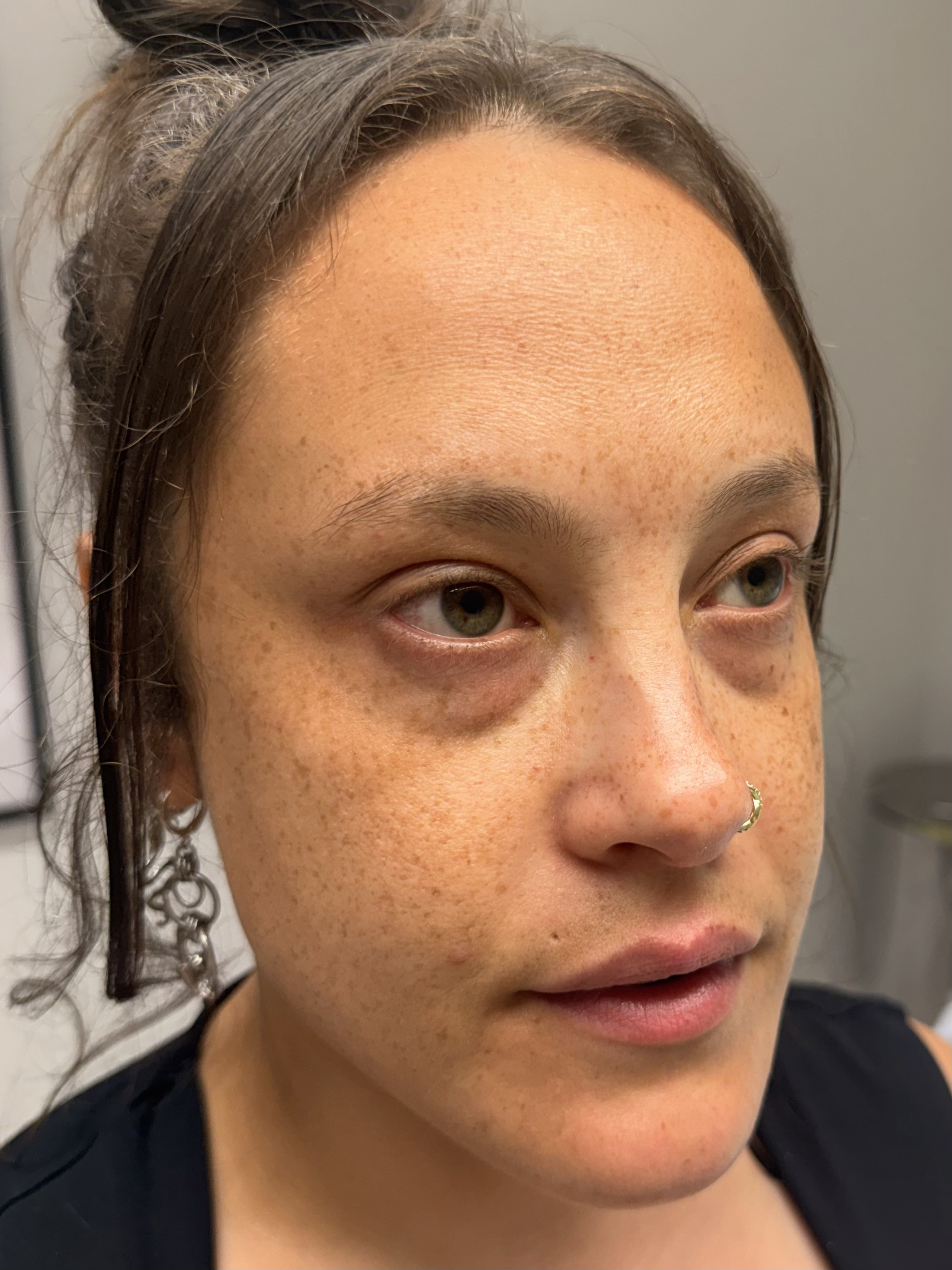Before — Dermal filler full face rejuvenation before and after in Manchester