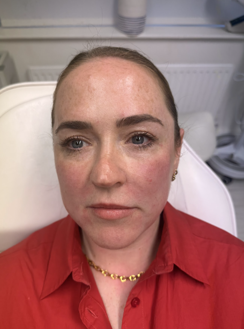 After — Jawline and chin dermal filler before and after at Skiin Clinic Manchester