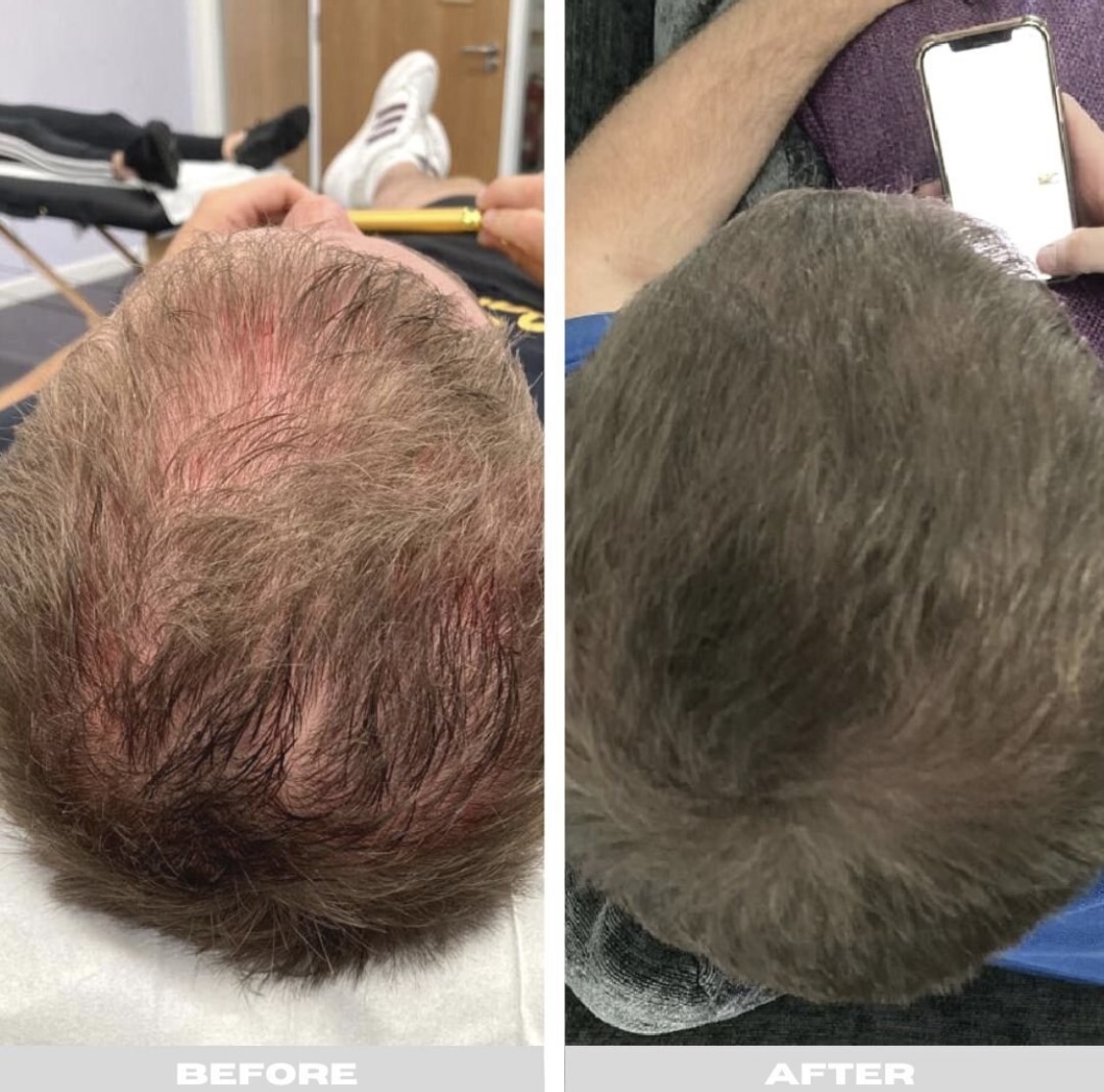 After — PRP hair restoration before and after at Skiin Manchester — visible increase in hair density