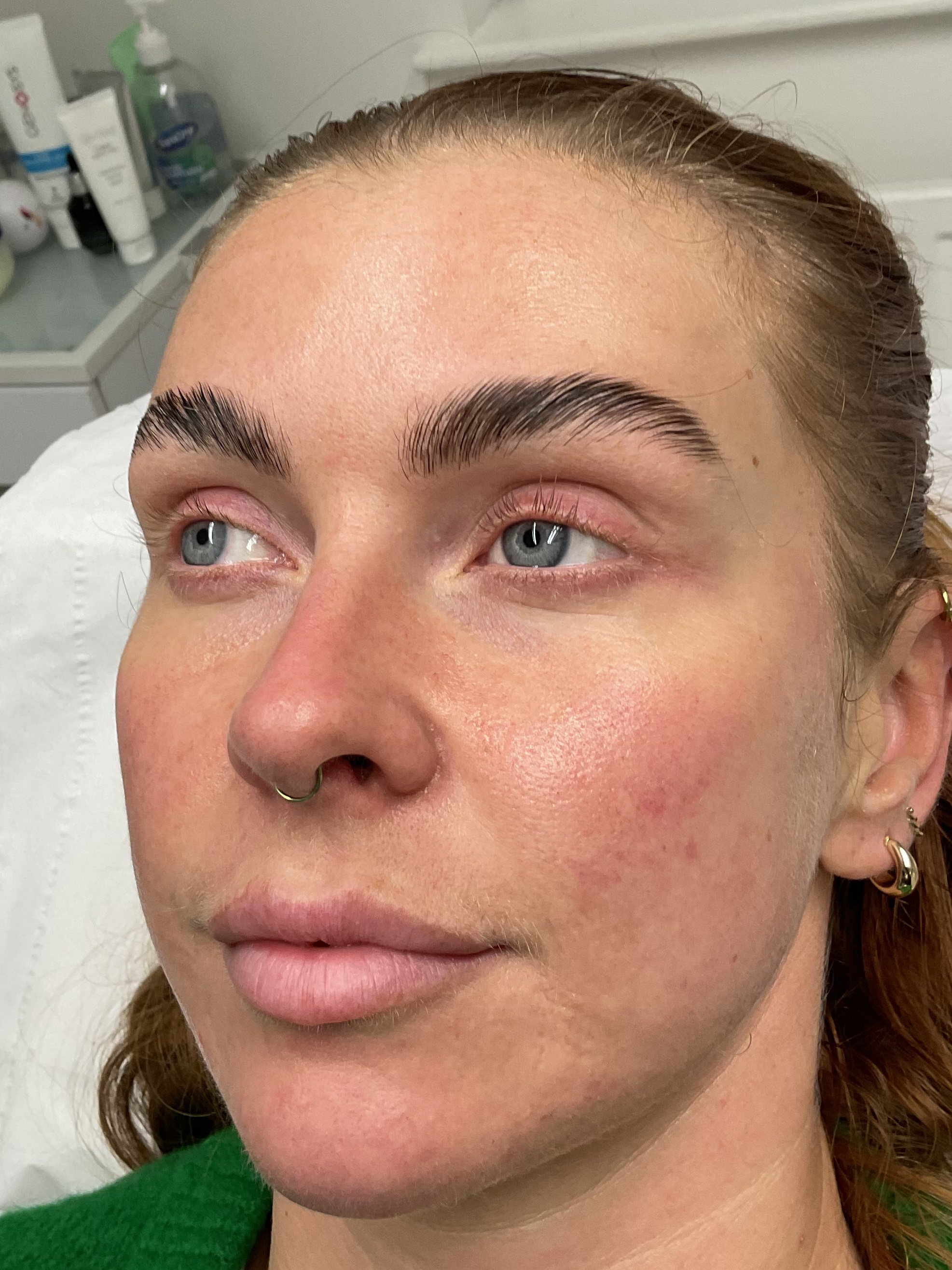 Before — Natural lip filler before and after — volume and hydration at Skiin Manchester