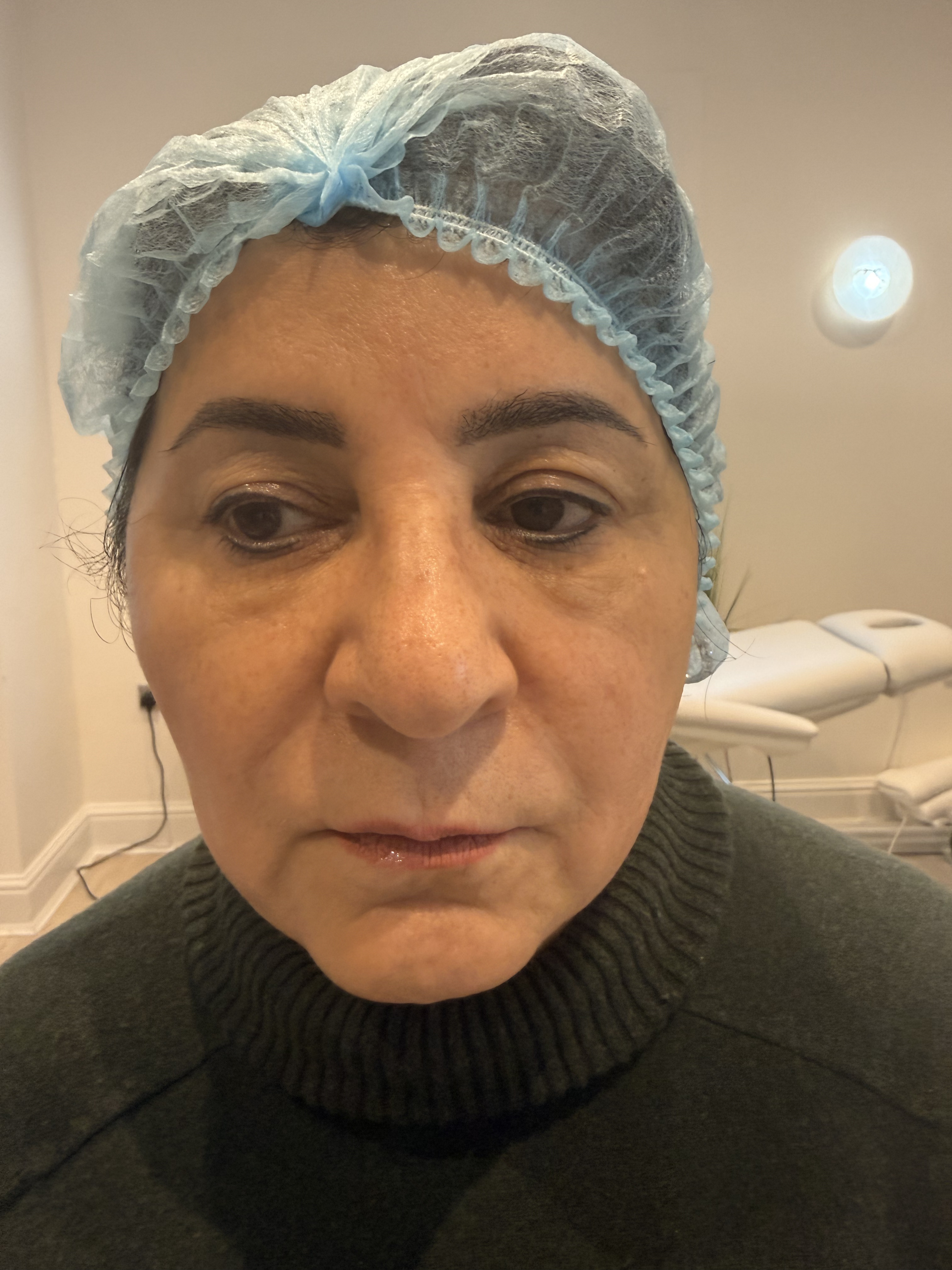 Before — Radiesse collagen stimulating filler before and after at Skiin Clinic Manchester