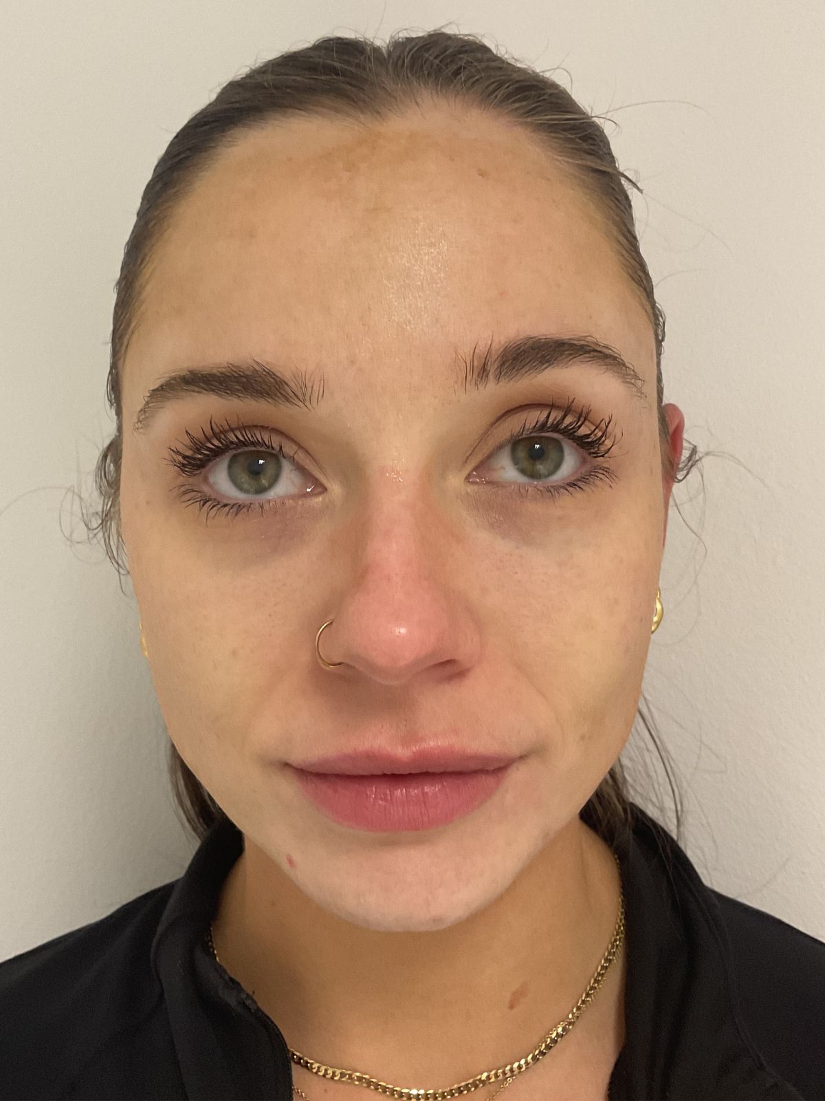 Before — LaseMD Ultra laser pigmentation treatment before and after in Manchester