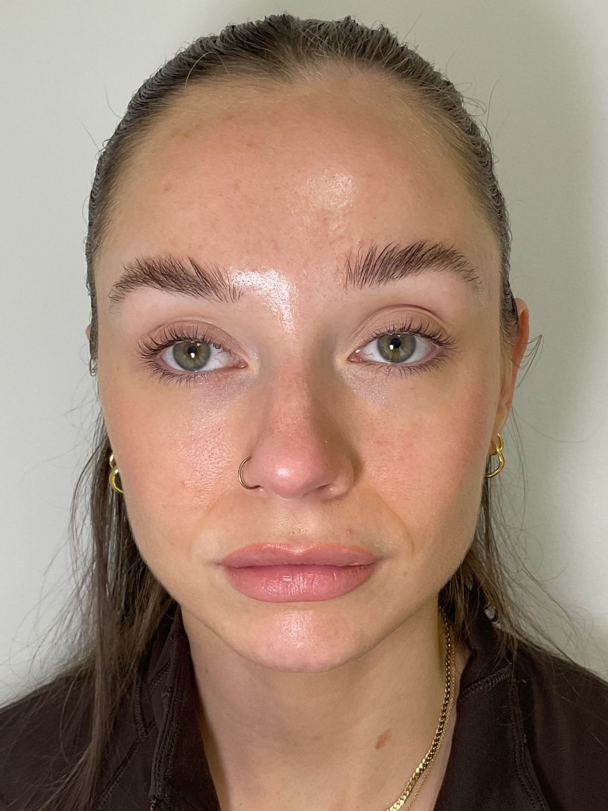 After — LaseMD Ultra laser pigmentation treatment before and after in Manchester