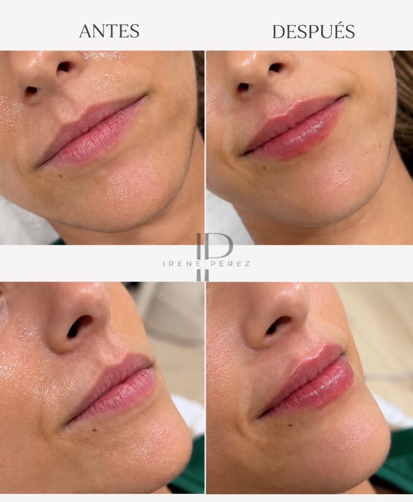 Antes y después de aumento de labios