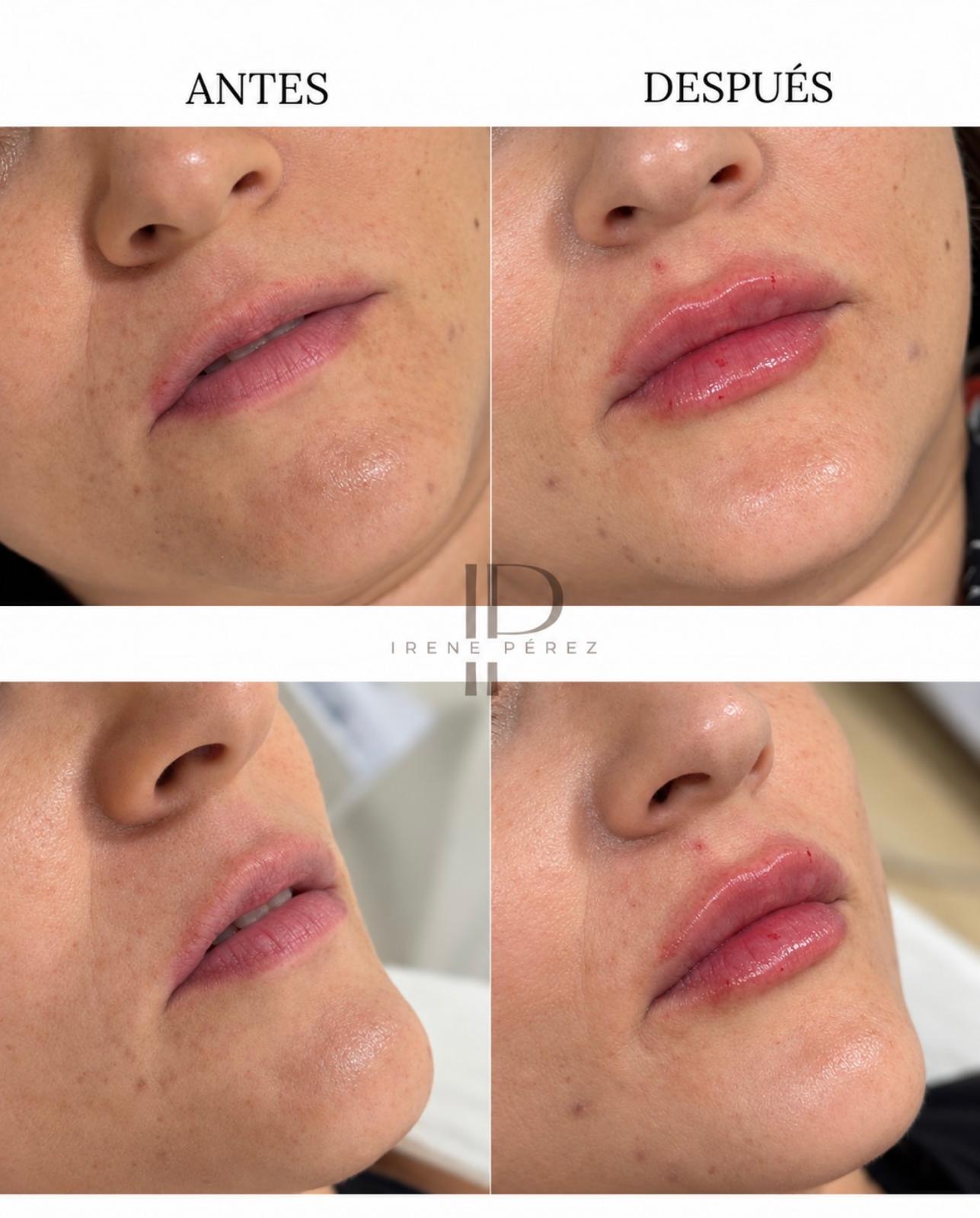 Antes y después de hidratación de labios