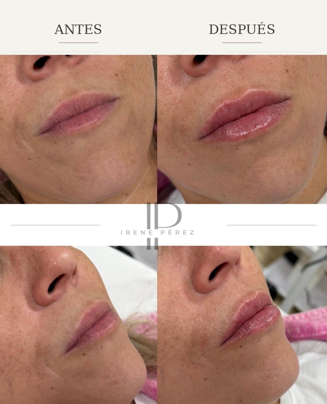 Antes y después de perfilado de labios