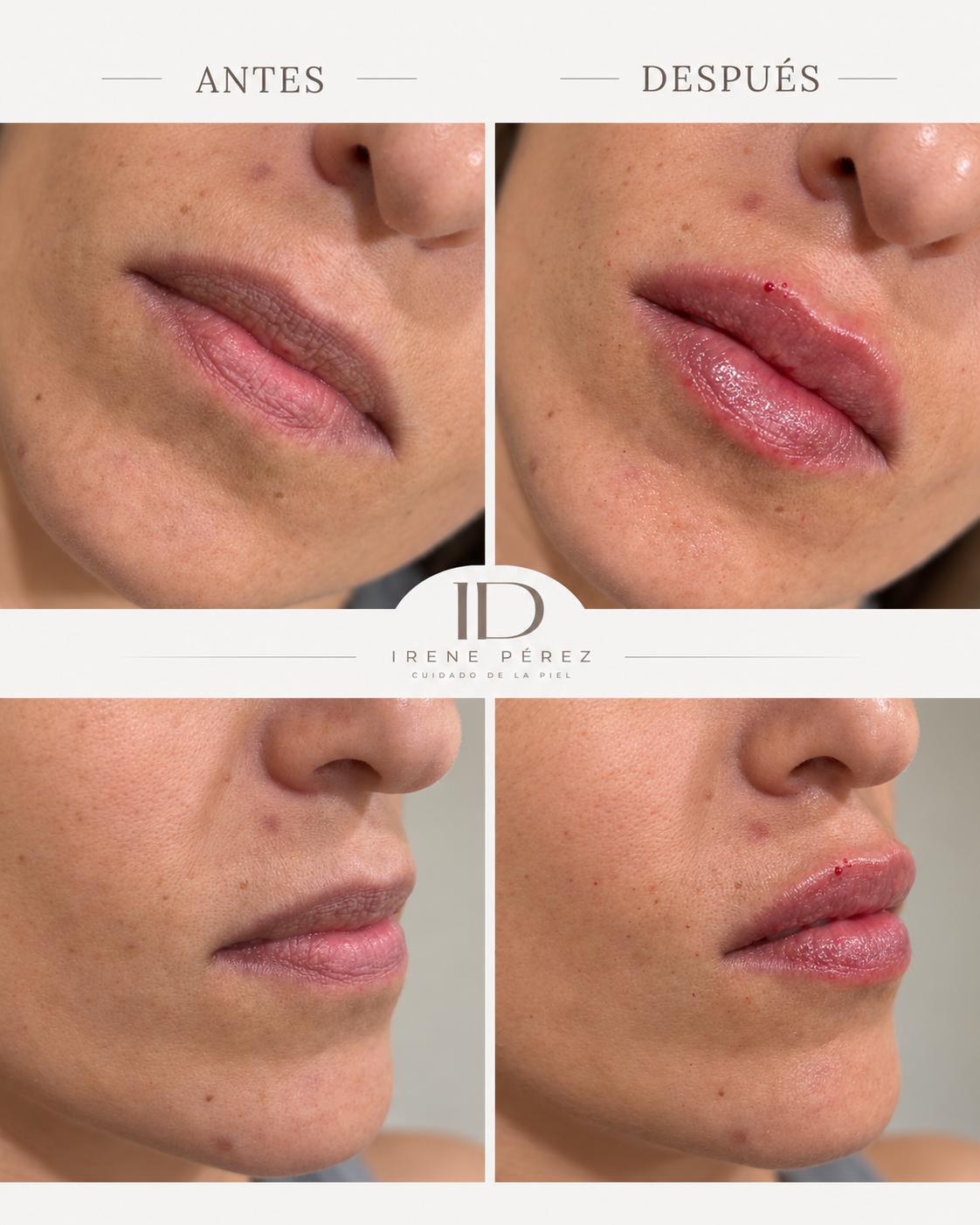 Antes y después de aumento de labios