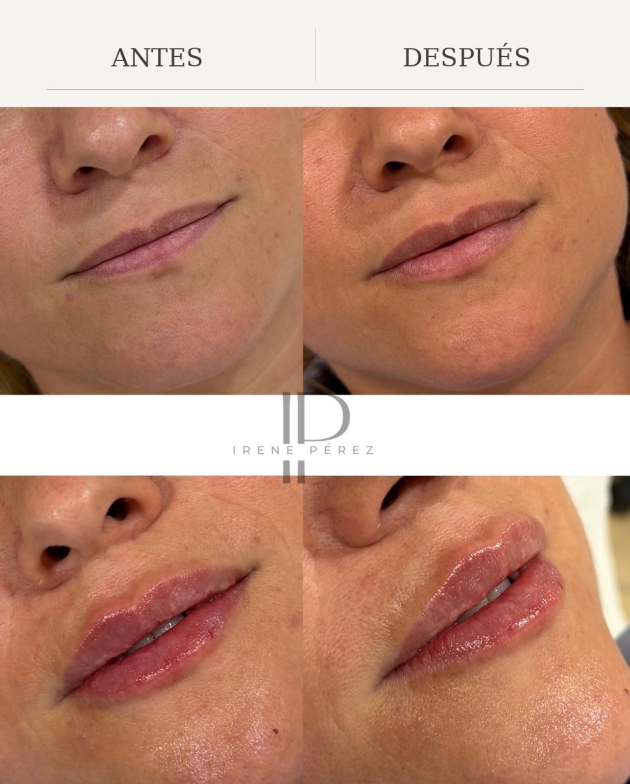 Antes y después de definición de labios