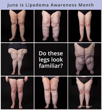June is Lipedema Awareness Month — do these legs look familiar? A photo comparison showing different presentations of lipoedema.