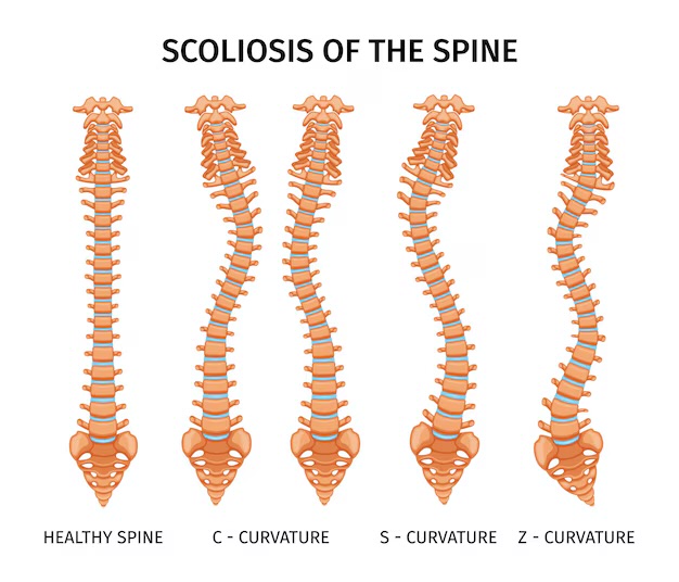 Scoliosis Awareness Month: Why Early Recognition Matters