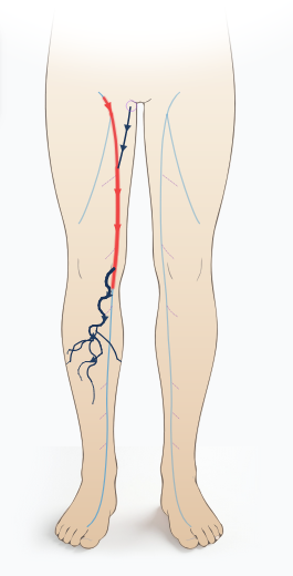 Draw varicose tributaries & perforators