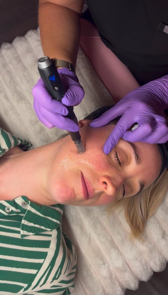 Microneedling treatment being performed