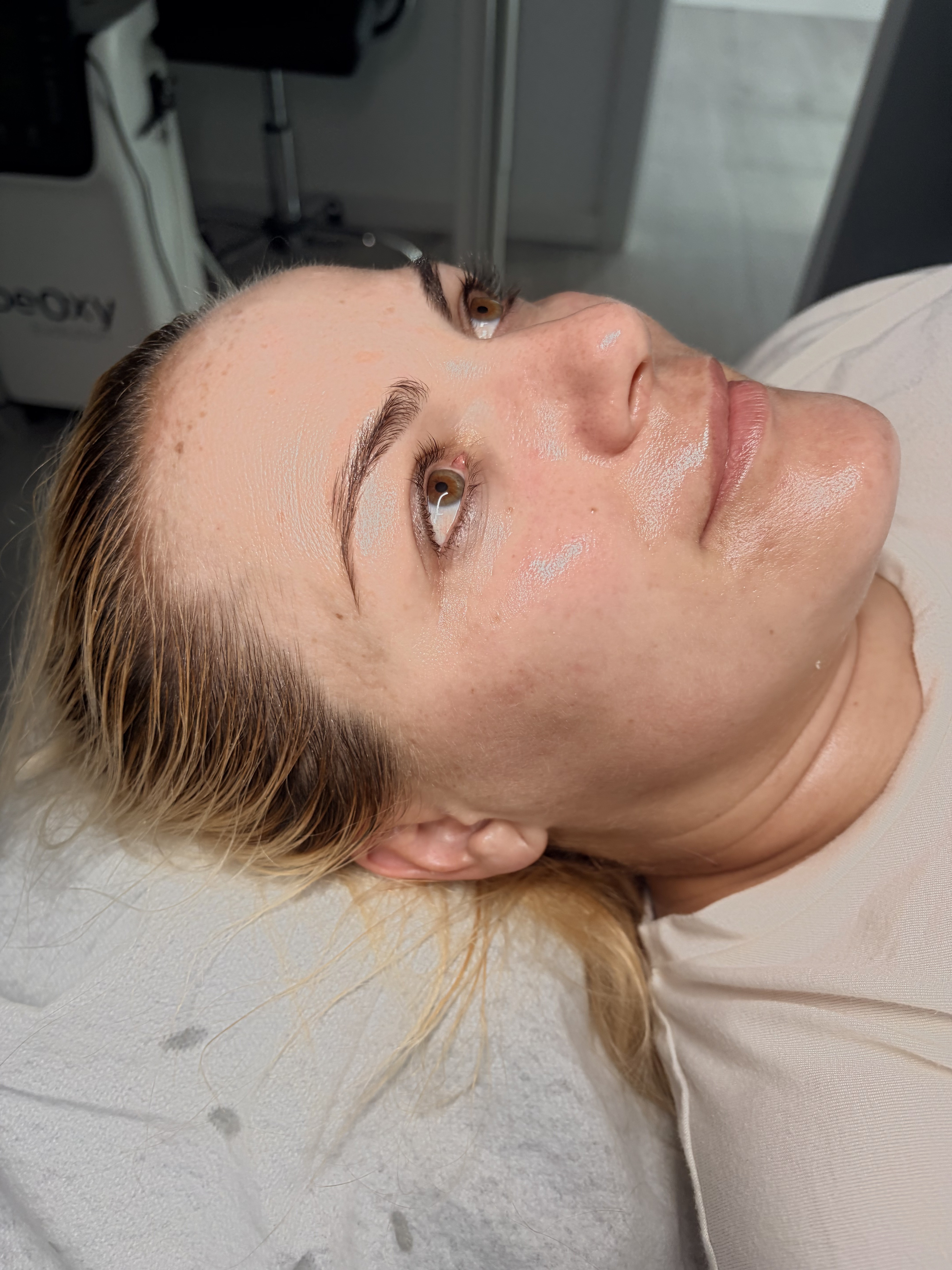 Después del tratamiento de Diatermia facial en Clínica ISIS Benalmádena