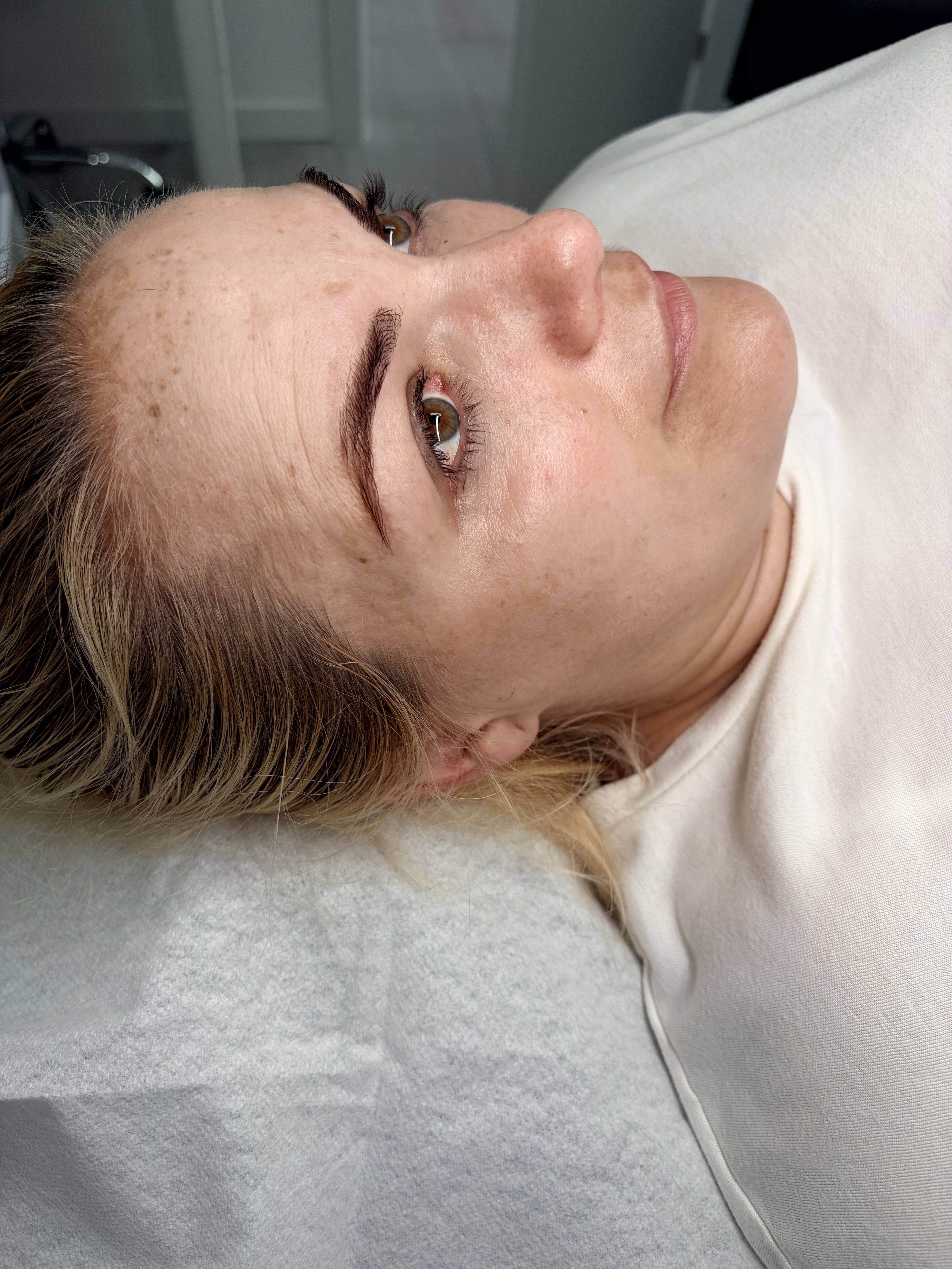 Antes del tratamiento de Diatermia facial en Clínica ISIS Benalmádena