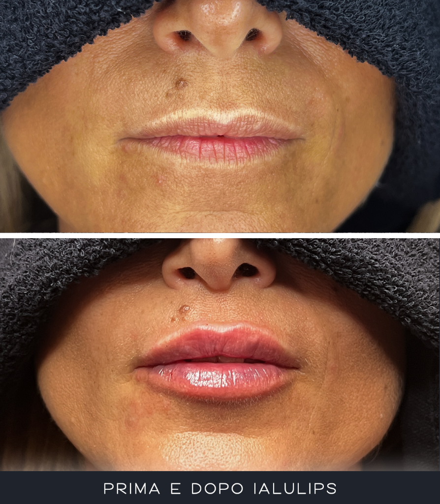 IALU Lips
