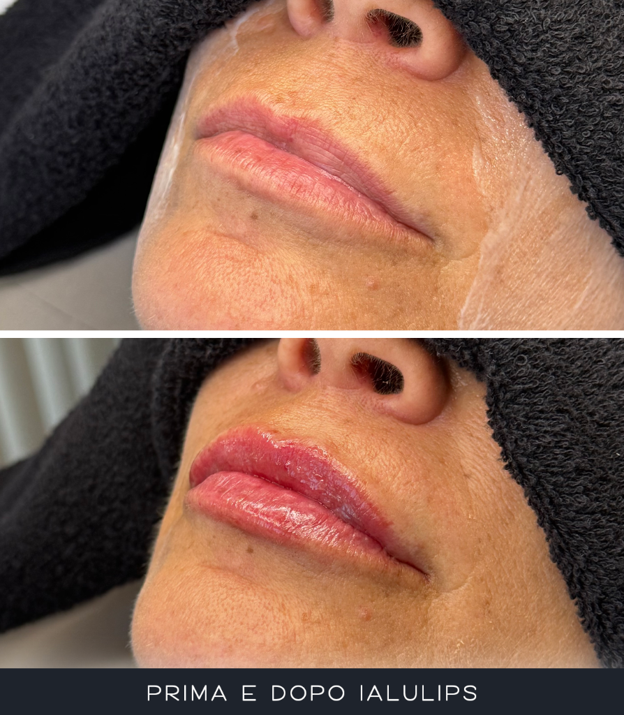 IALU Lips