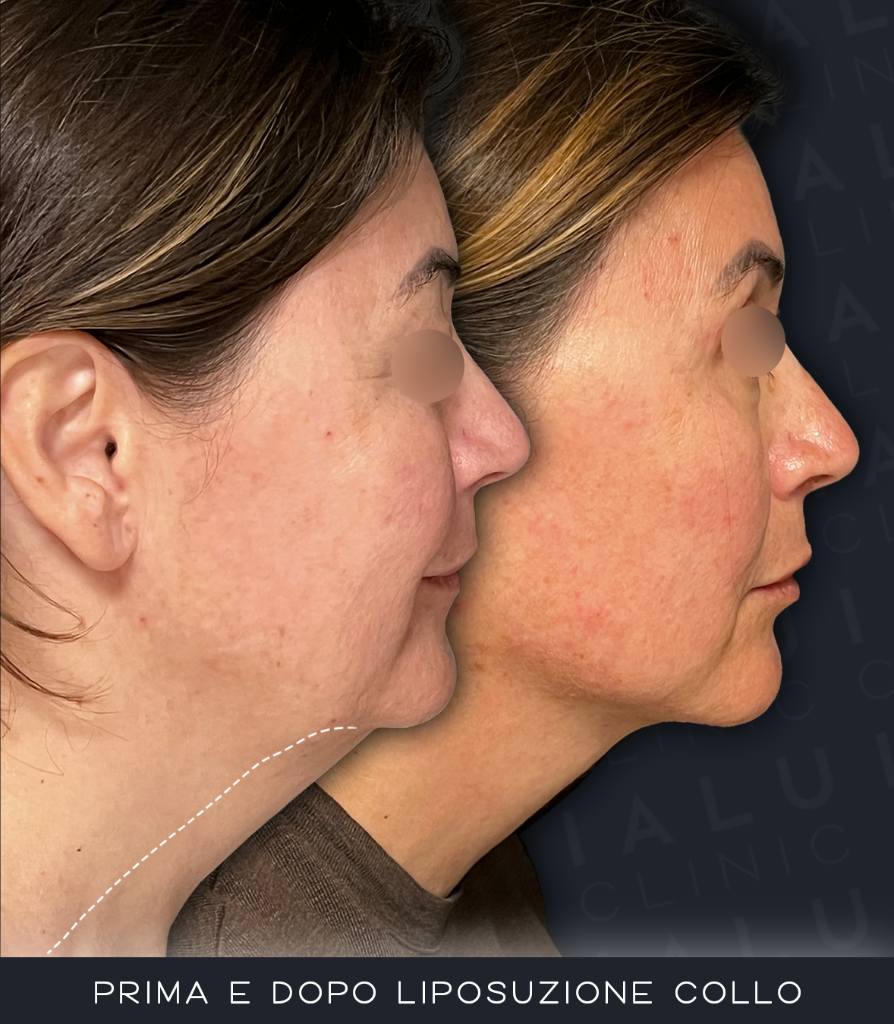 Liposuzione collo