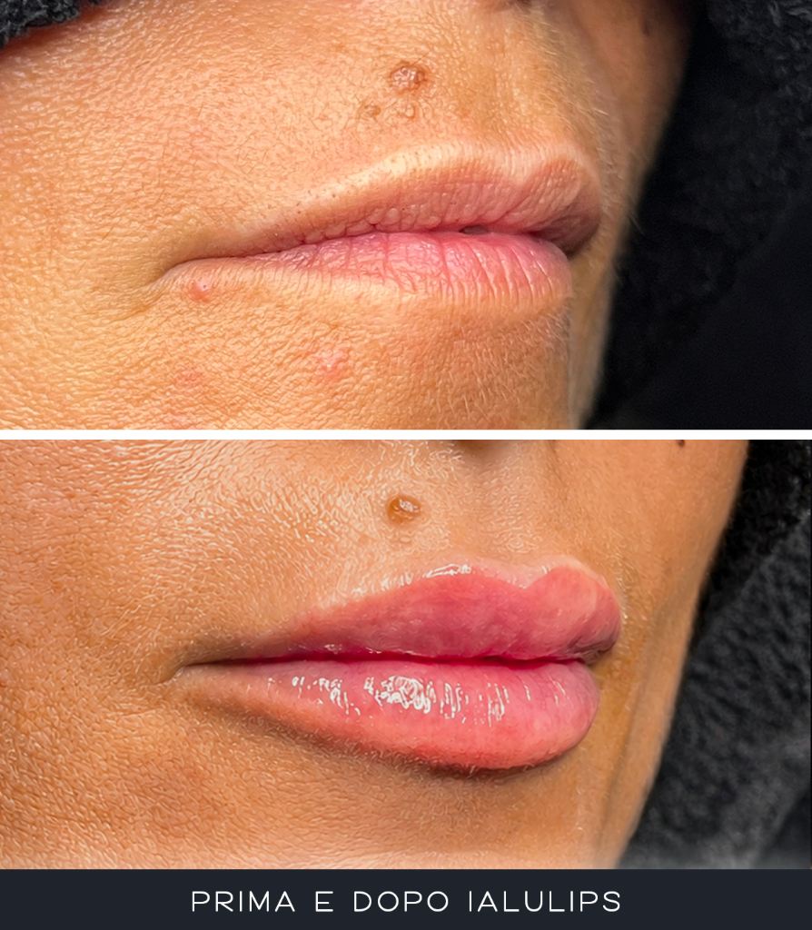 IALU Lips