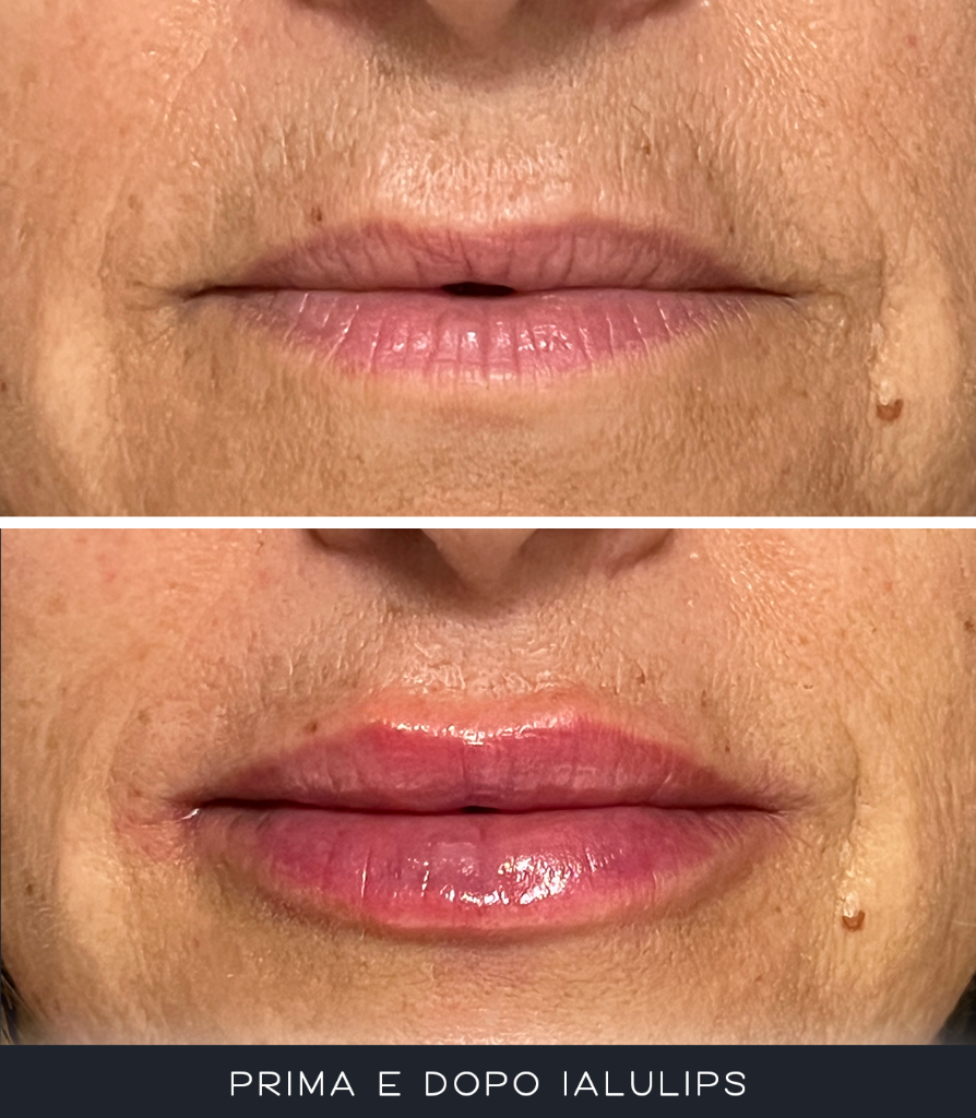 IALU Lips