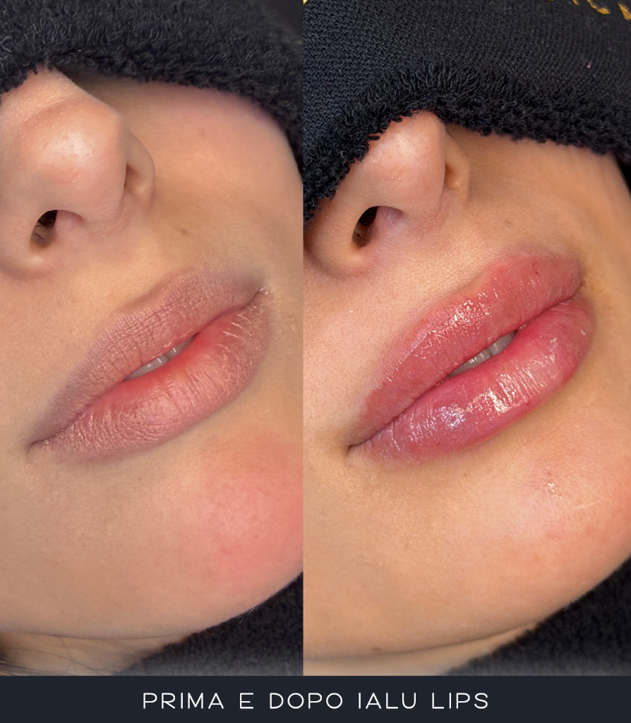IALU Lips