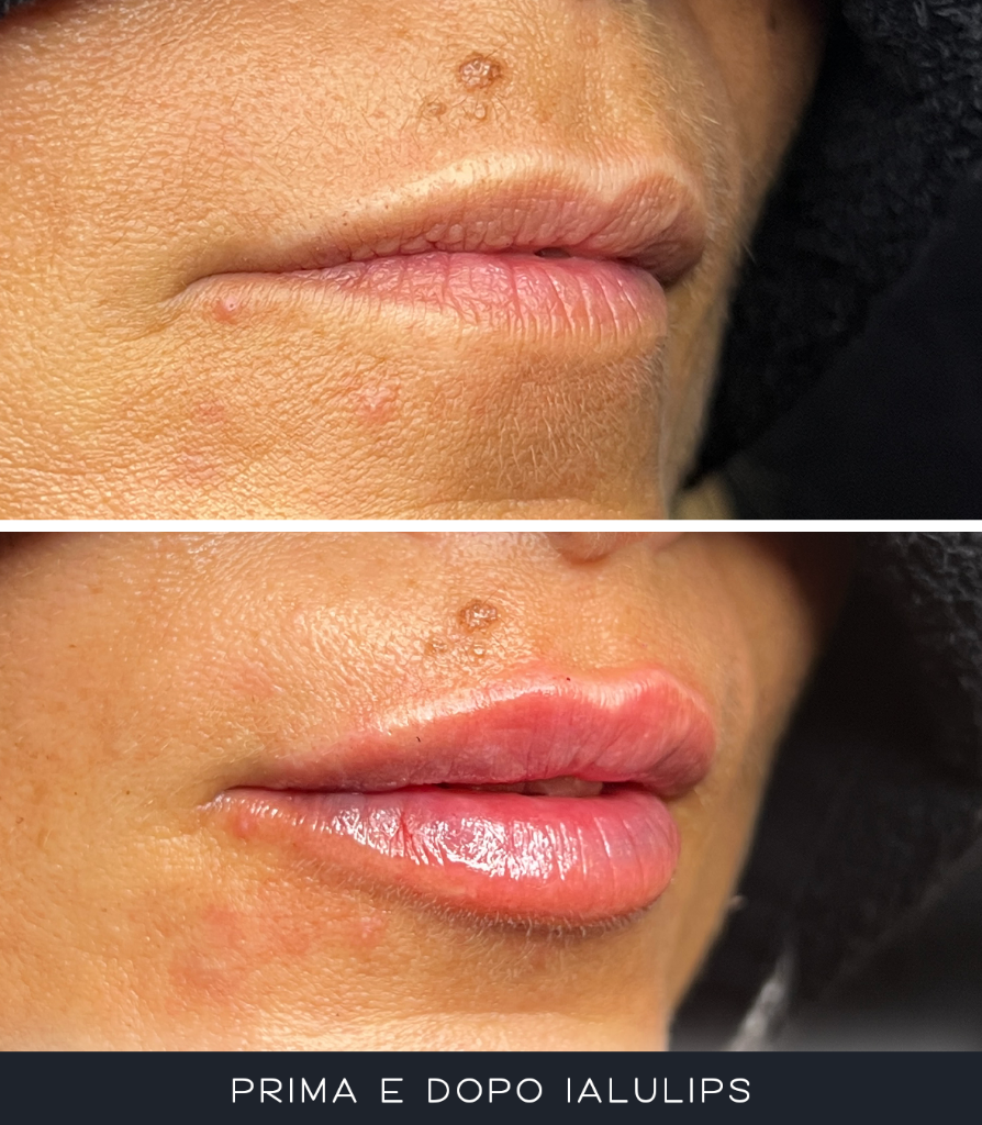IALU Lips