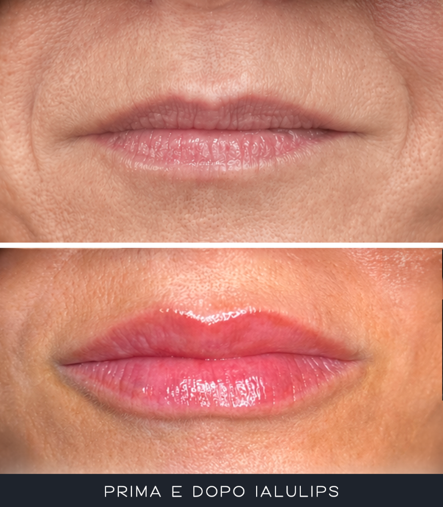 IALU Lips