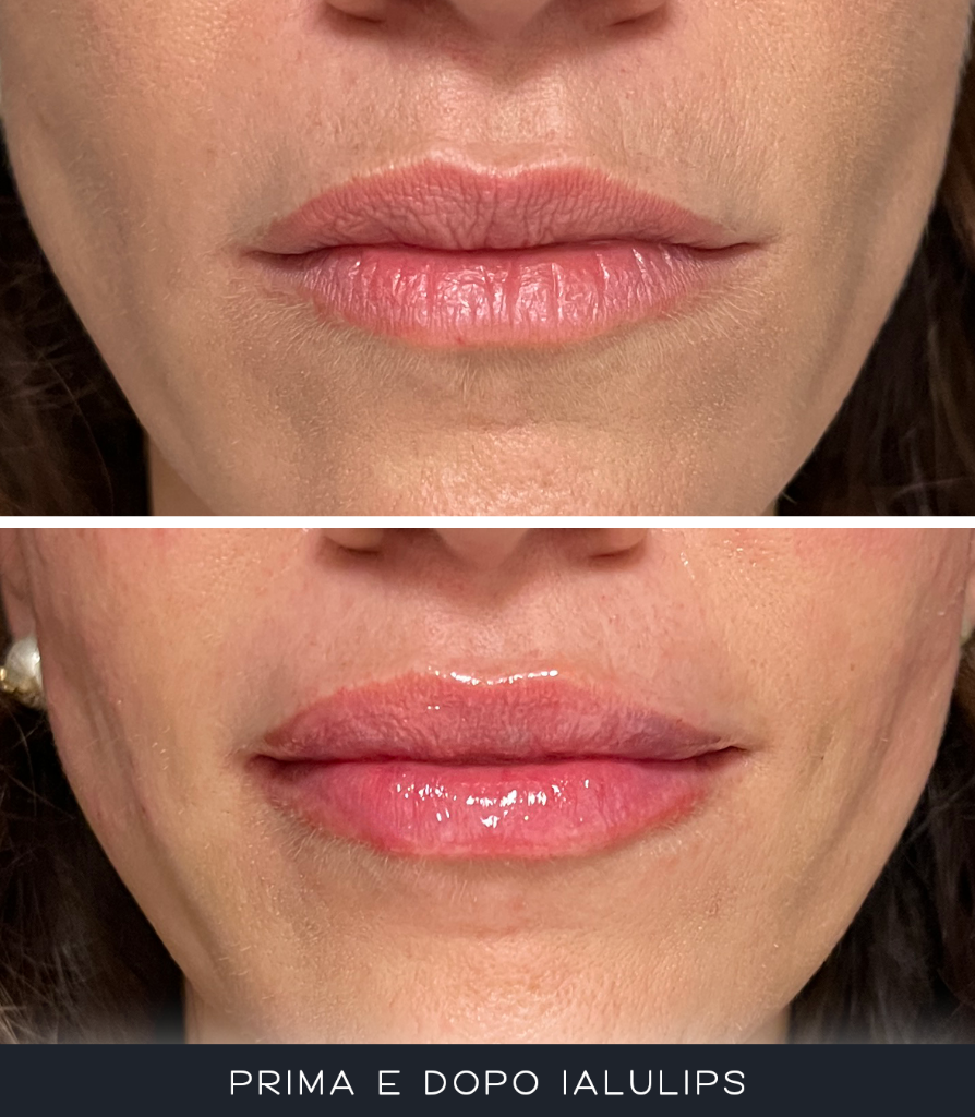 IALU Lips