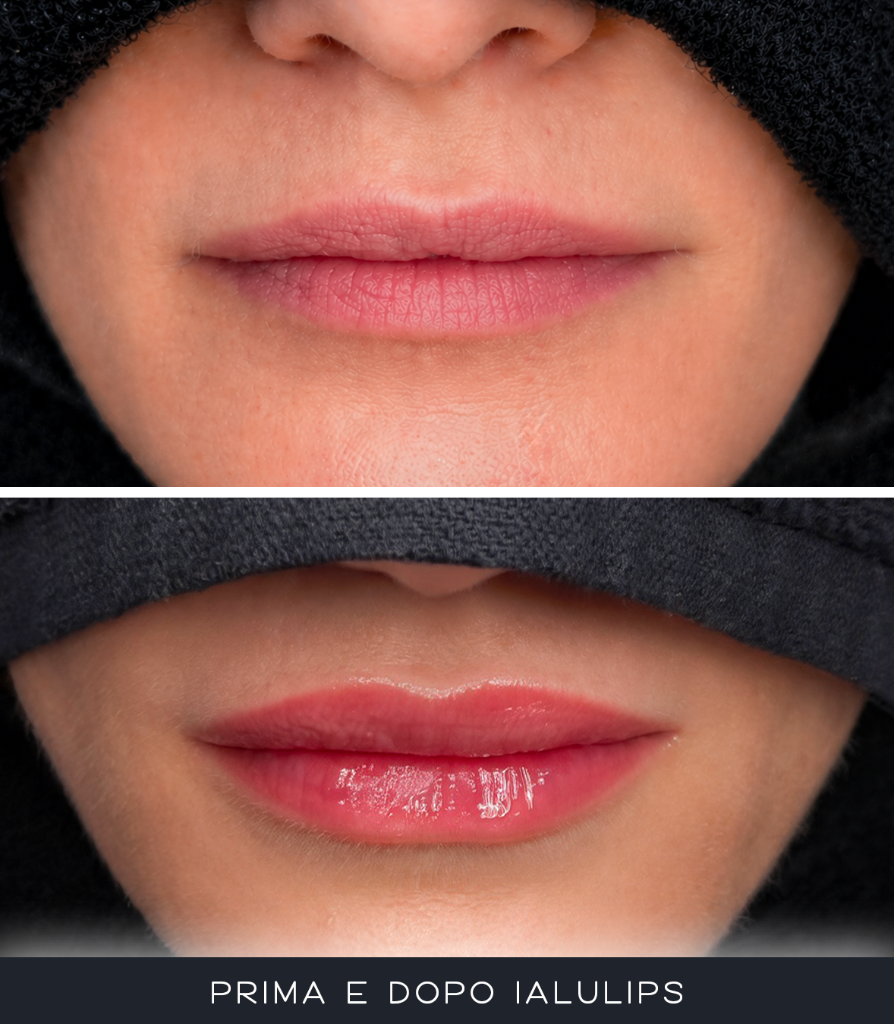 IALU Lips