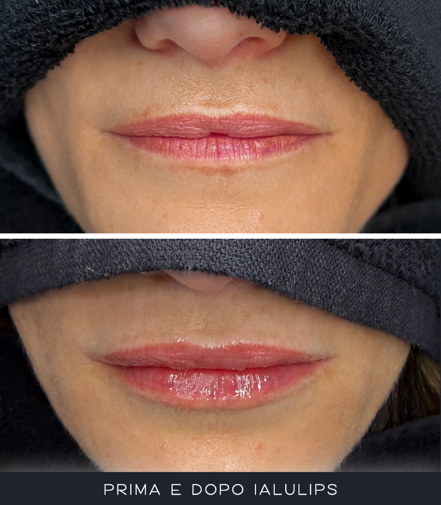 IALU Lips
