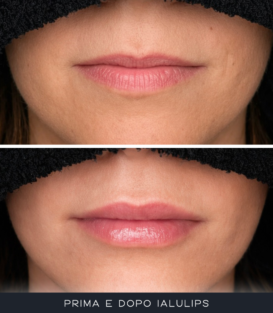 IALU Lips
