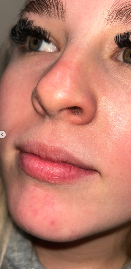 Fillers before