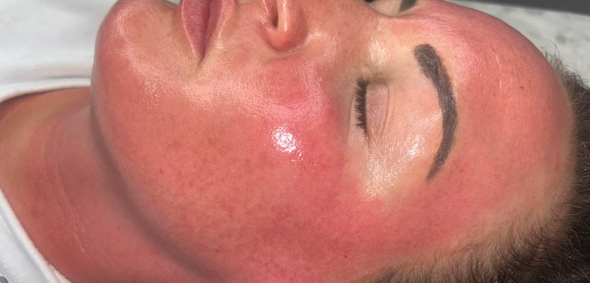 Skin after