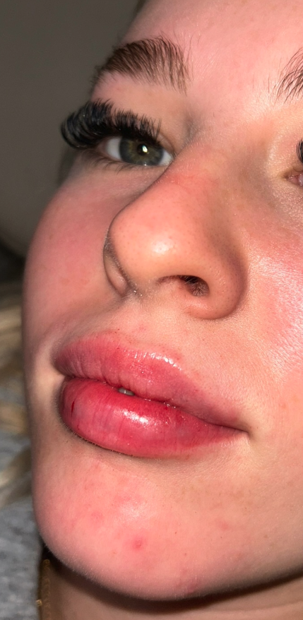 Fillers after