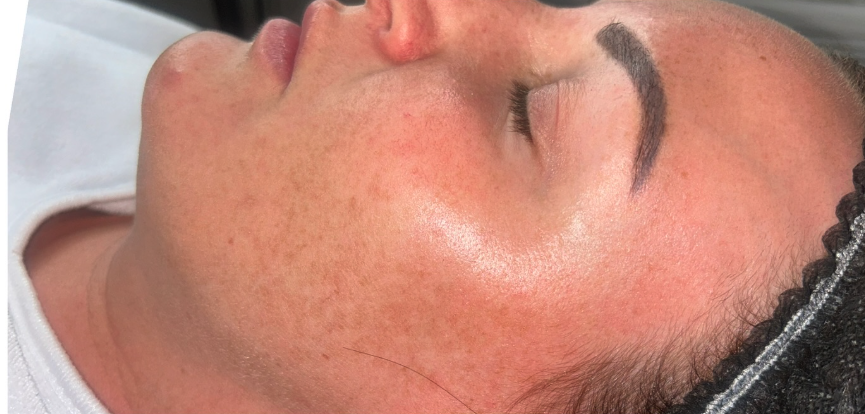 Skin before