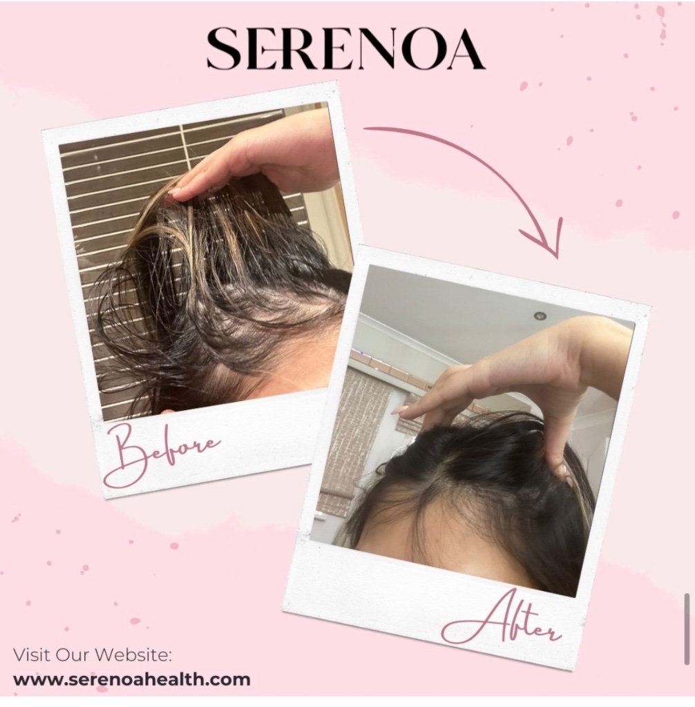 Crown thinning — visible regrowth after 90 days