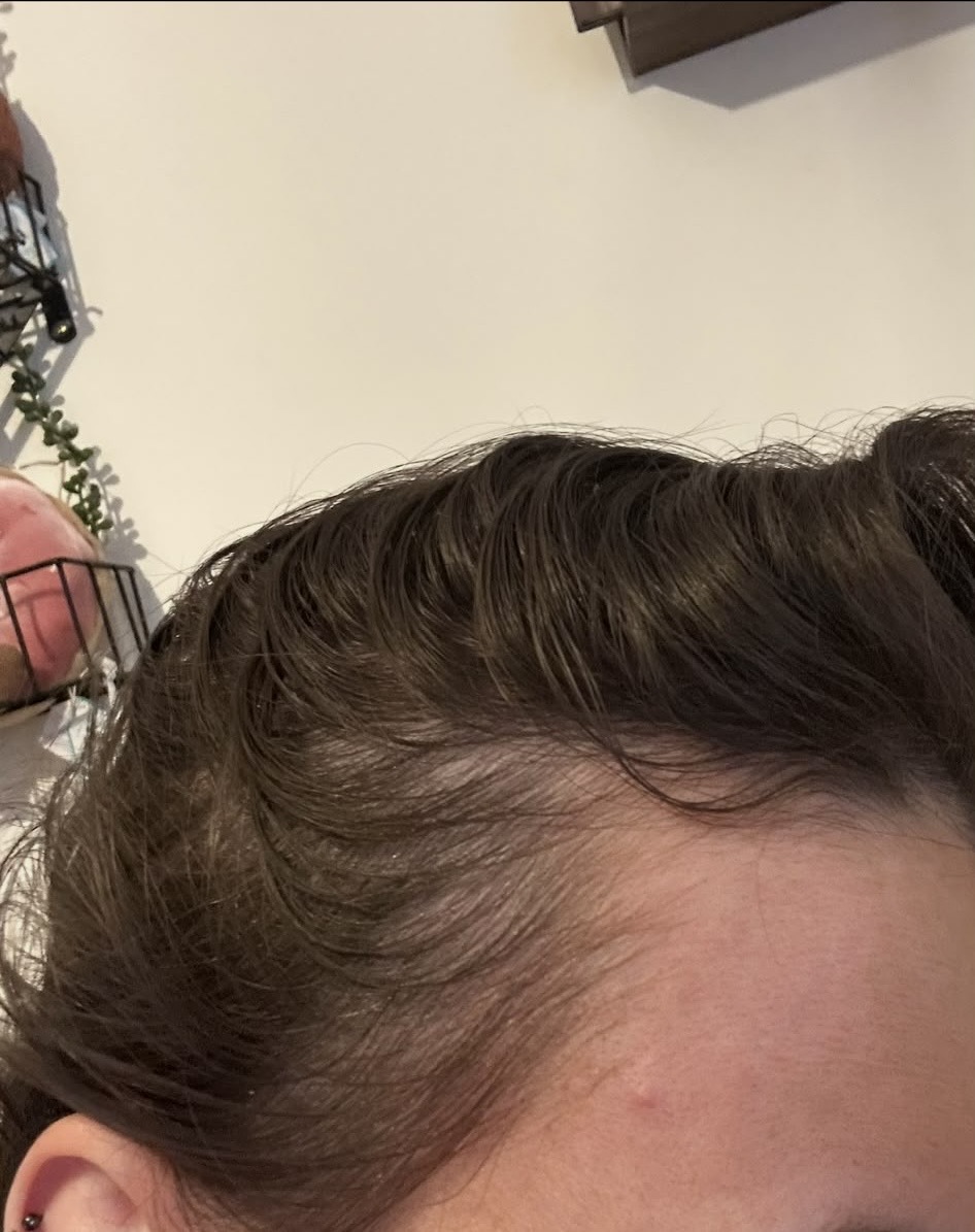 Before — Customer-reported progress after 12 weeks (about 3 months) of Wonder Pill use