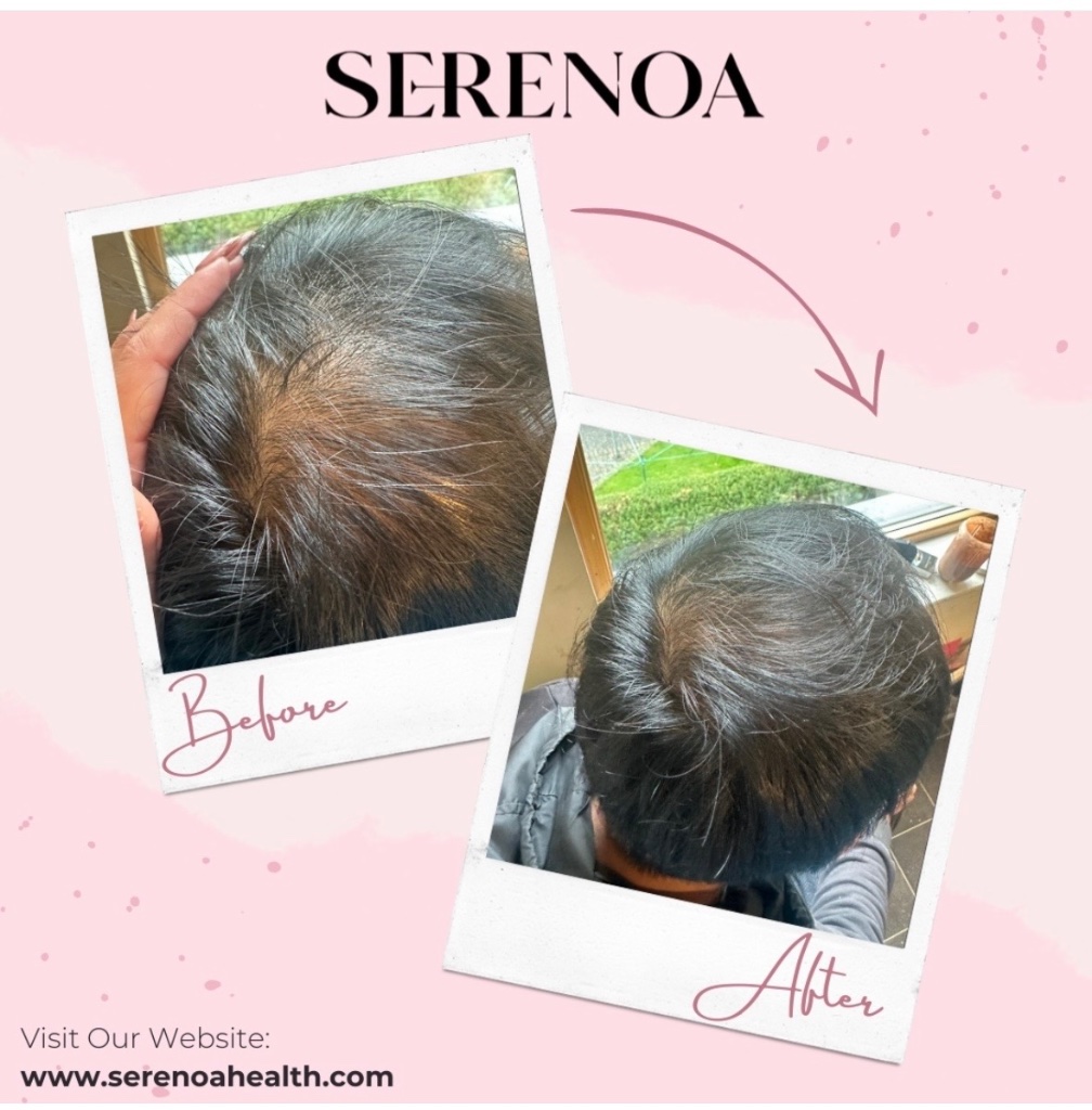 Scalp showing — fuller coverage after 3 months